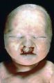 C6 trisomy13 facies.jpg