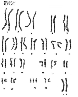 Синдром дауна лишняя хромосома. Синдром Дауна 21 хромосома. Кариотип человека с синдромом Дауна.