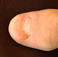 190px-Nailpatellakleur1fotojanwij.jpg